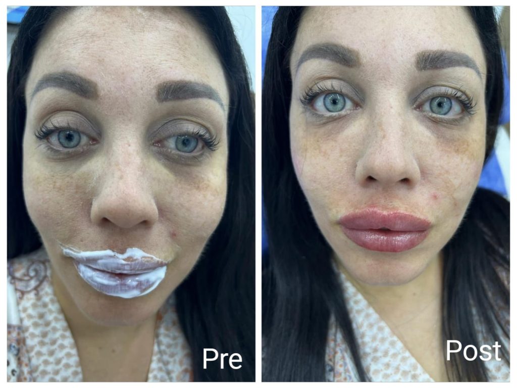 Lip augmentation at Nadara Medspa in Hurghada